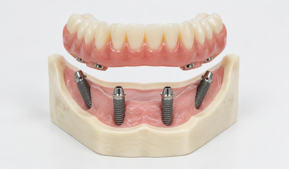 Clinical illustration of fixed implant dentures